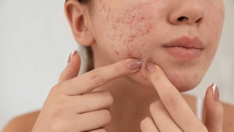 Tratamentos dermatológicos para espinhas